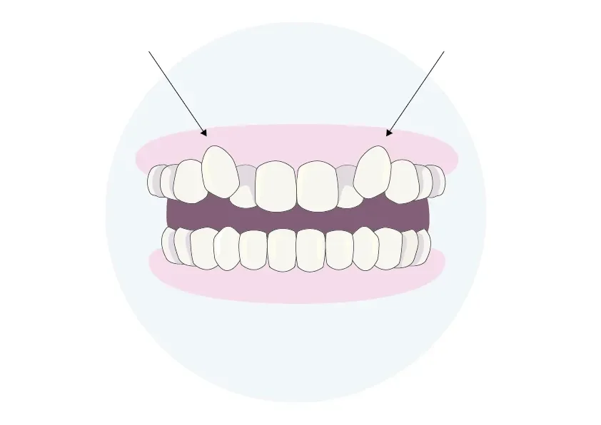 Grafische Darstellung eines Oberkiefers mit Zahnfehlstellung