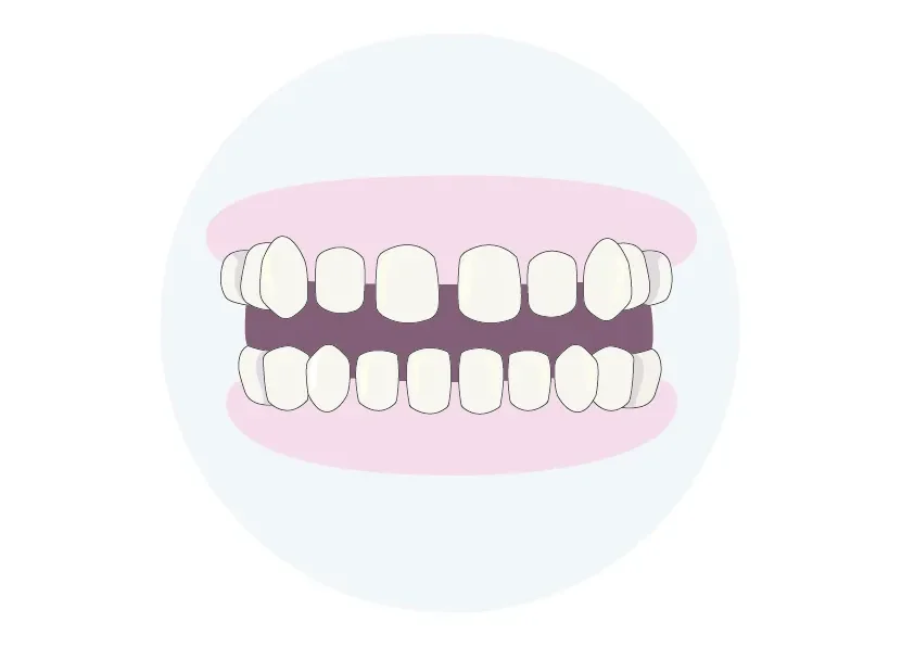 Platzüberschuss im gebiss grafik