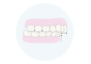 Unterkiefer Rücklage (Kl2)