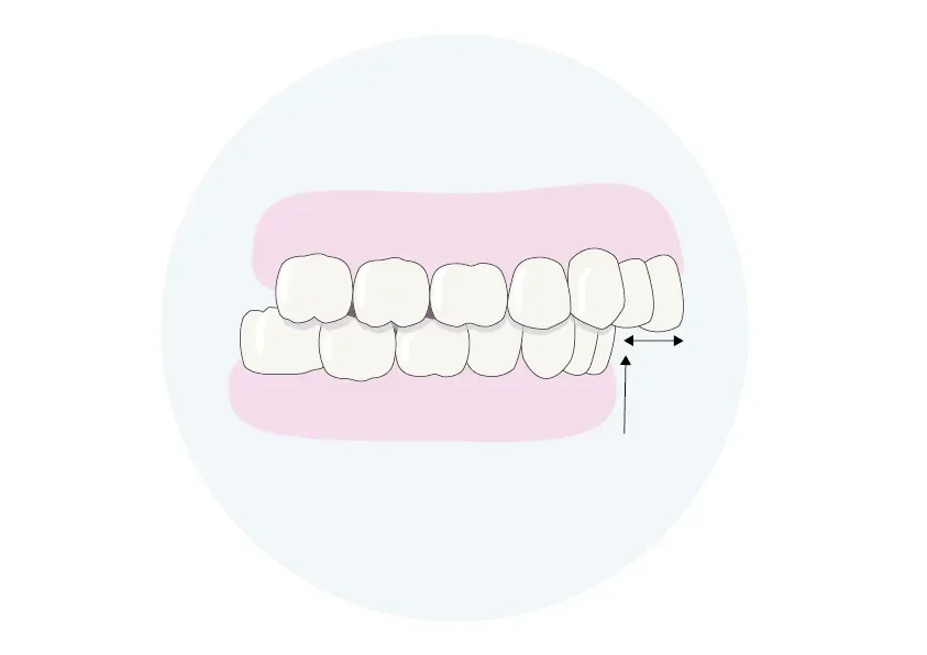 Unterkiefer Rücklage (Kl2)