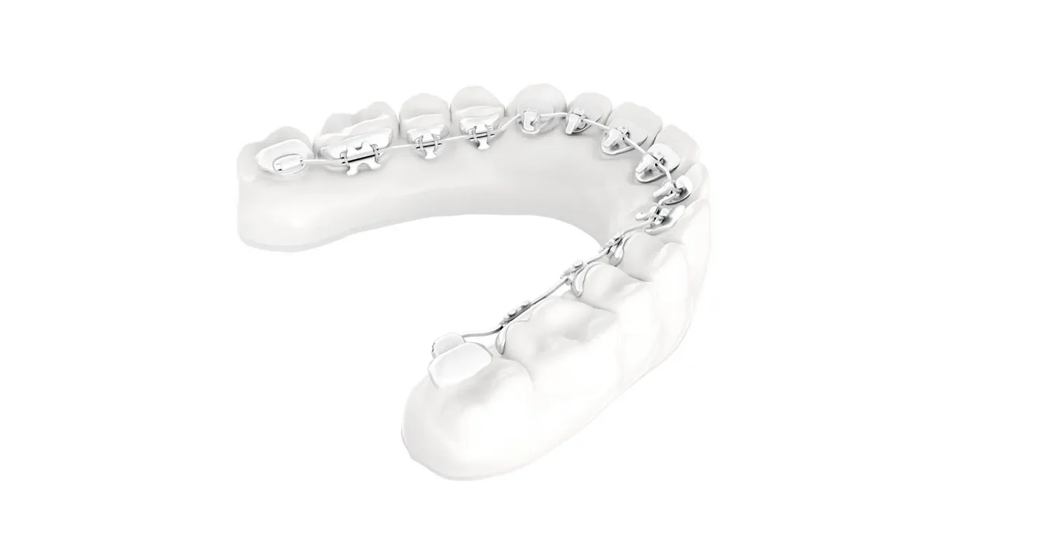 lingualtechnik zahnspange