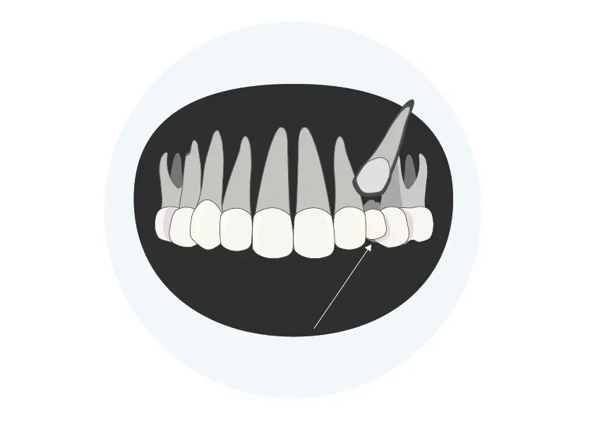 retinierte und impaktierte Zähne