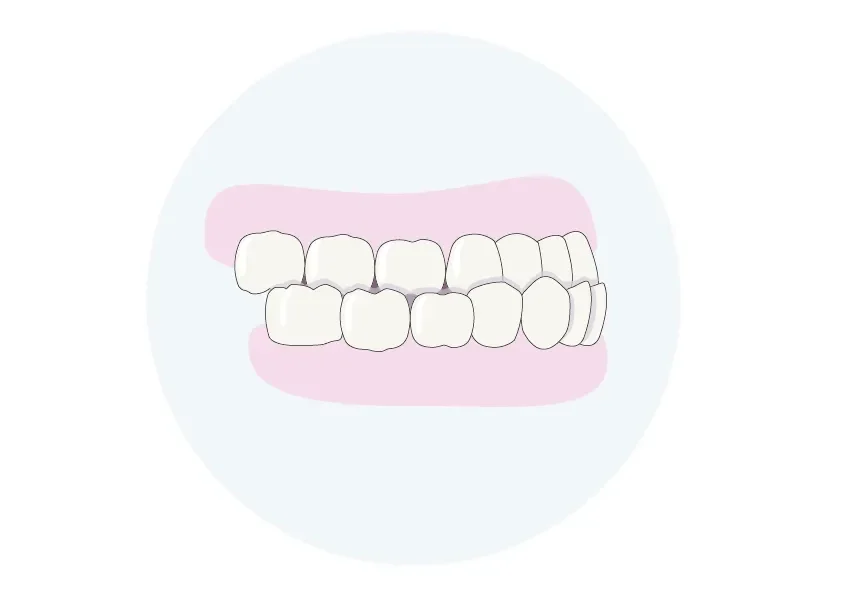 verkehrter Überbiss (Kl3) Vorbiss