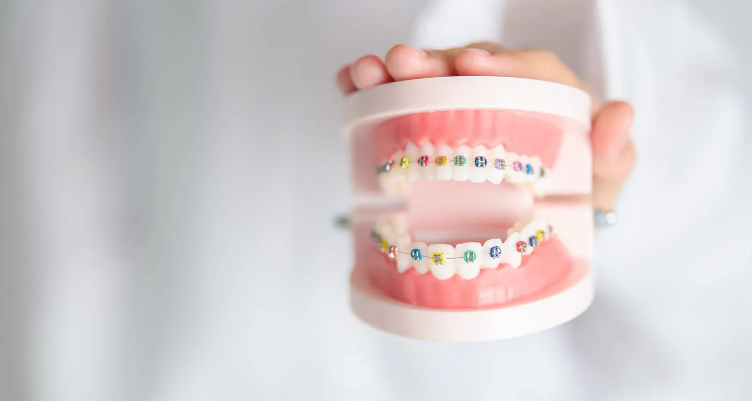 Modell eines Kiefers mit bunten festen Zahnspangen